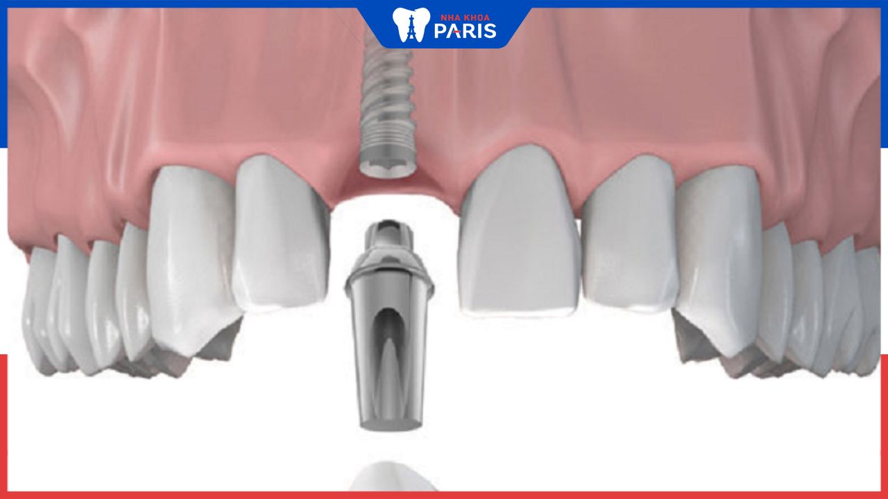 Cắm Implant răng cửa: Những điều cần biết trước khi thực hiện